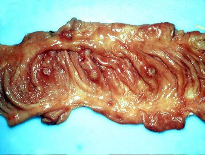 Lesión necróticas en tejidos linfoides del intestino grueso (botones pestosos) en formas subagudas